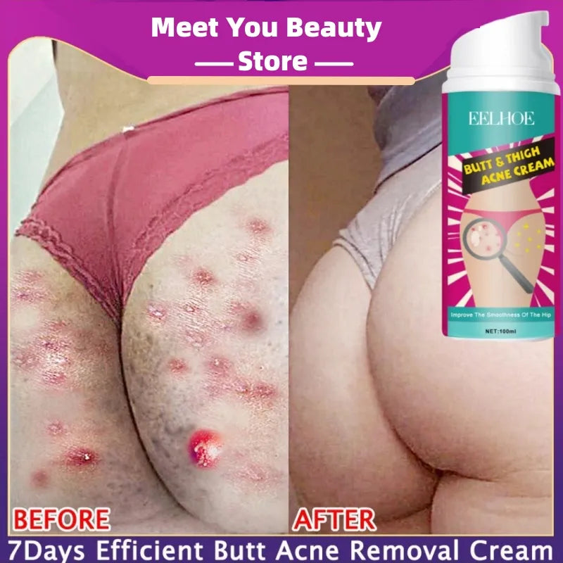 100ml Butt Thigh Acne Clearing Spot Treatment Cream Whiten Clears Acne Pimples Zit Razor Bumps Buttock Pore Clogging Body Lotion