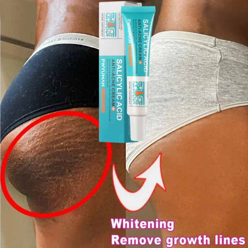 100ml Butt Thigh Acne Clearing Spot Treatment Cream Whiten Clears Acne Pimples Zit Razor Bumps Buttock Pore Clogging Body Lotion